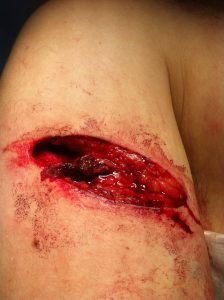 Phlipmode's bicep after being struck by a car door. 